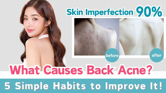 What Causes Back Acne? 5 Simple Habits to Improve It!
